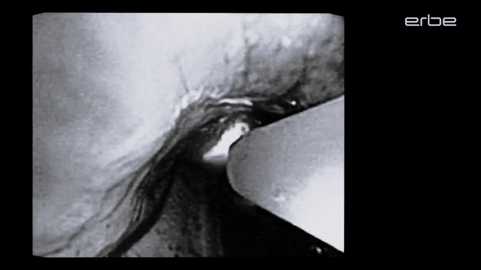 Hemostasis of tracheobronchial bleeding with APC 2