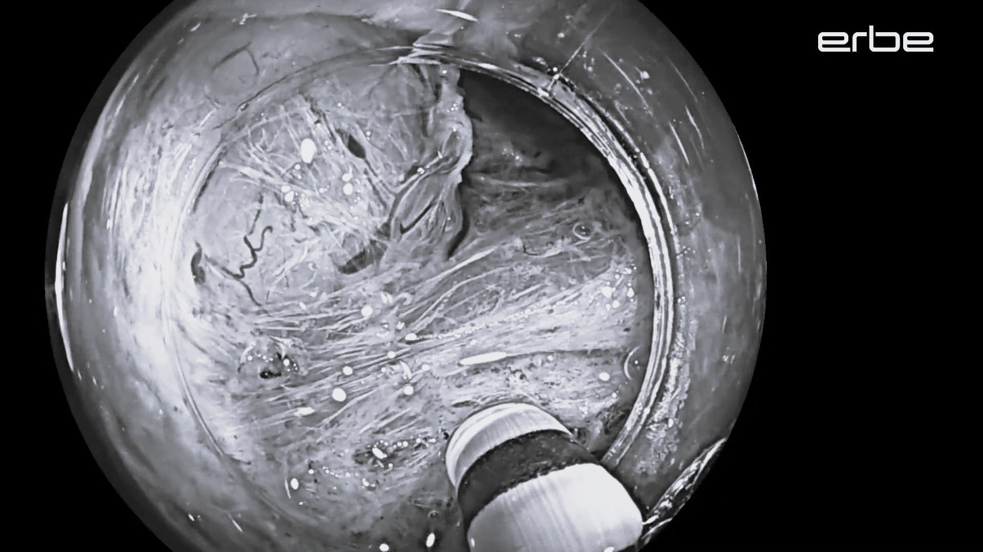 Prof. Maselli, M.D., Ph.D. | VIO® 3 and ERBEJET® 2 endoCUT® I, preciseSECT™, swiftCOAG® with HYBRIDknife flex® I-type
