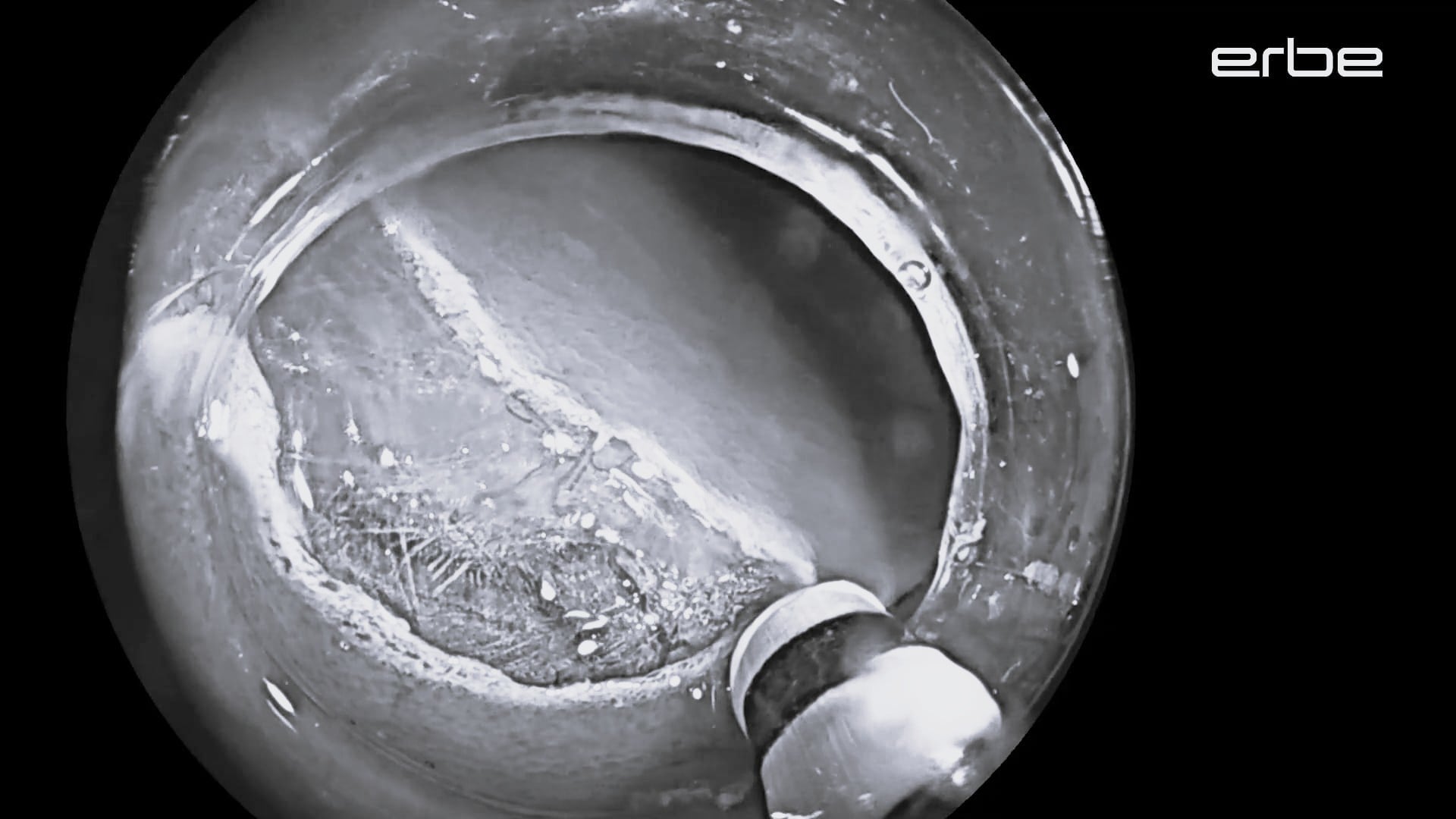 Prof. Repici | VIO® 3 and ERBEJET® 2 endoCUT® I, preciseSECT™, swiftCOAG® with HYBRIDknife flex® I-type