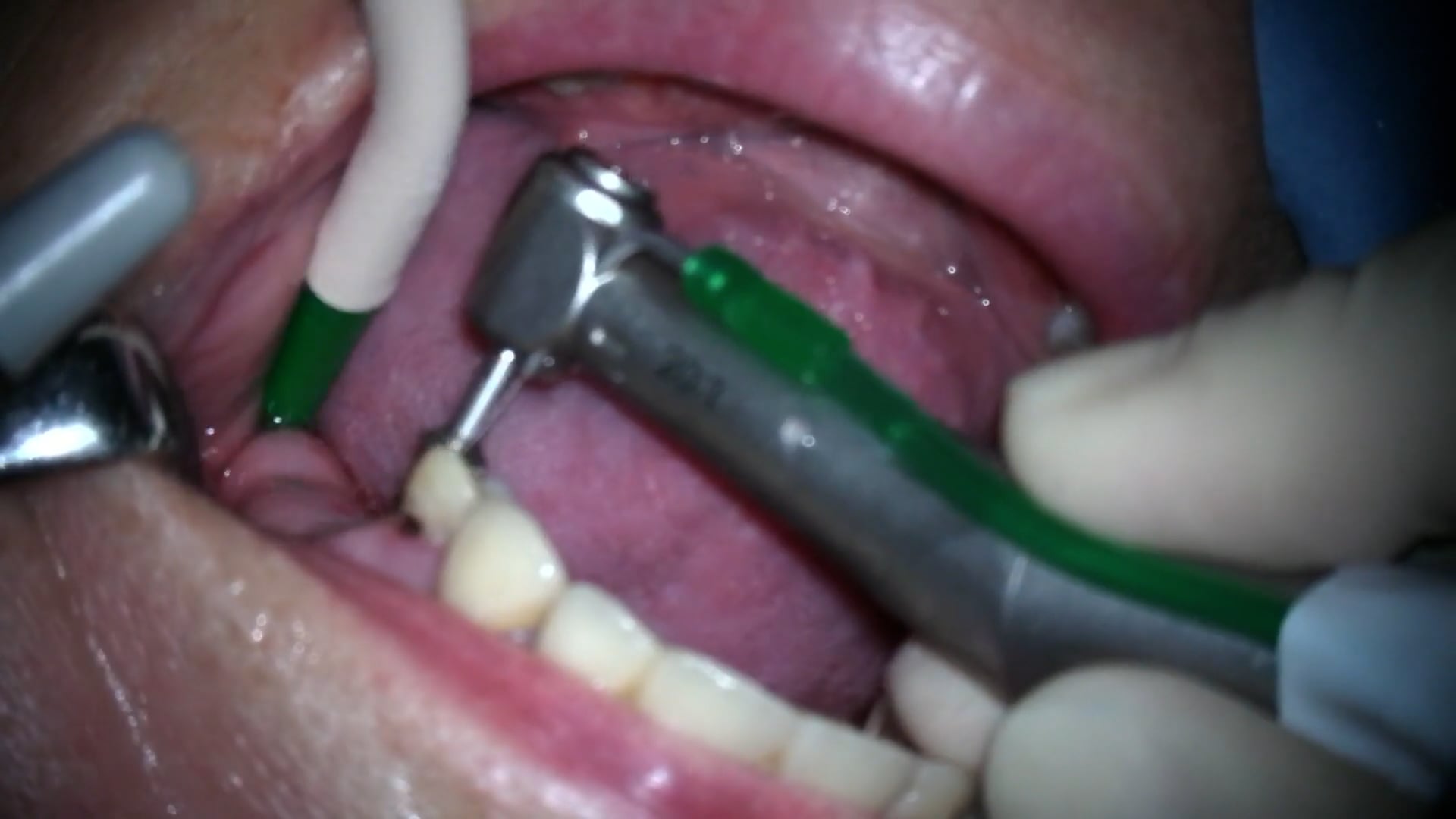 Colocación de implantes Flapless para rehabilitación de sector posterior maxilar