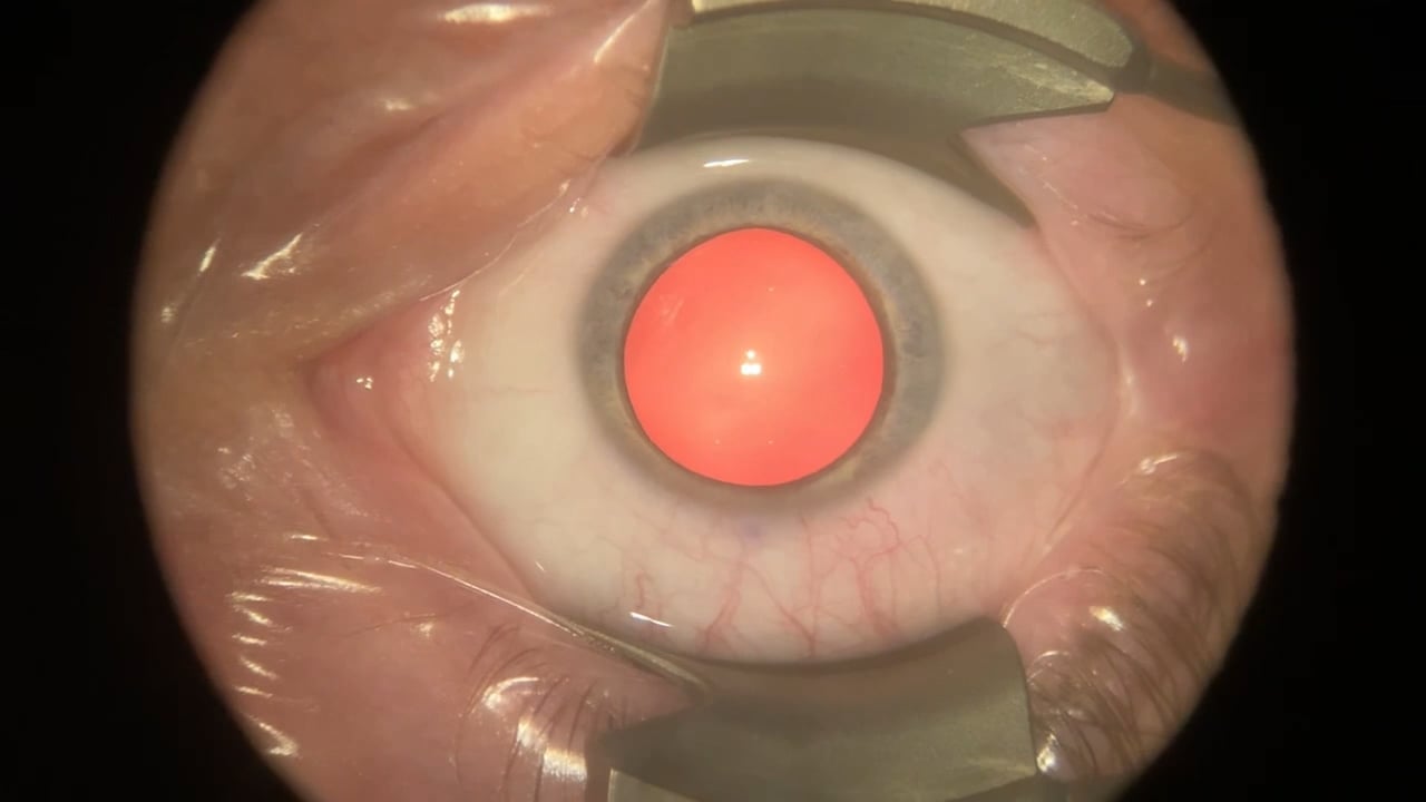 ICL Surgery (Aaron Waite) — EVO ICL
