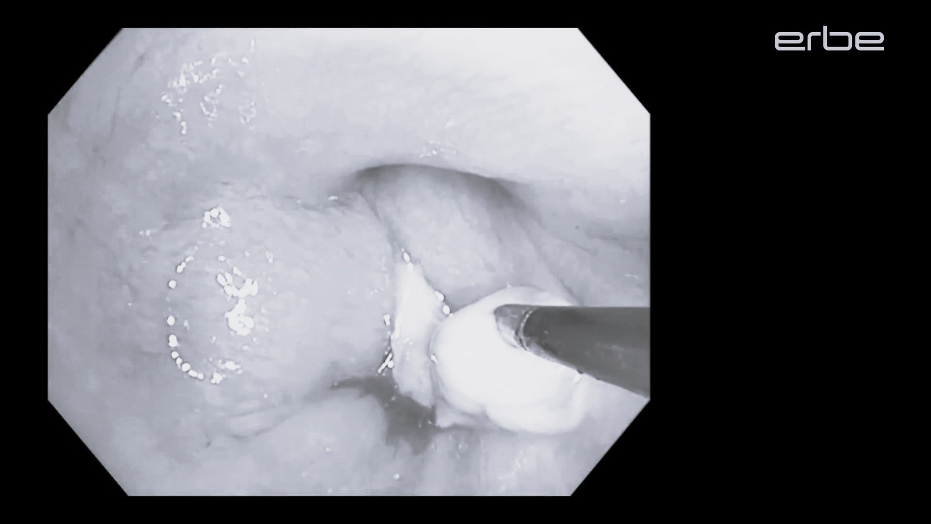 Mucous Plug Extraction | ERBECRYO 2 | 1.1mm Cryoprobe