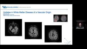 Updates in White Matter Disease of a Vascular Origin