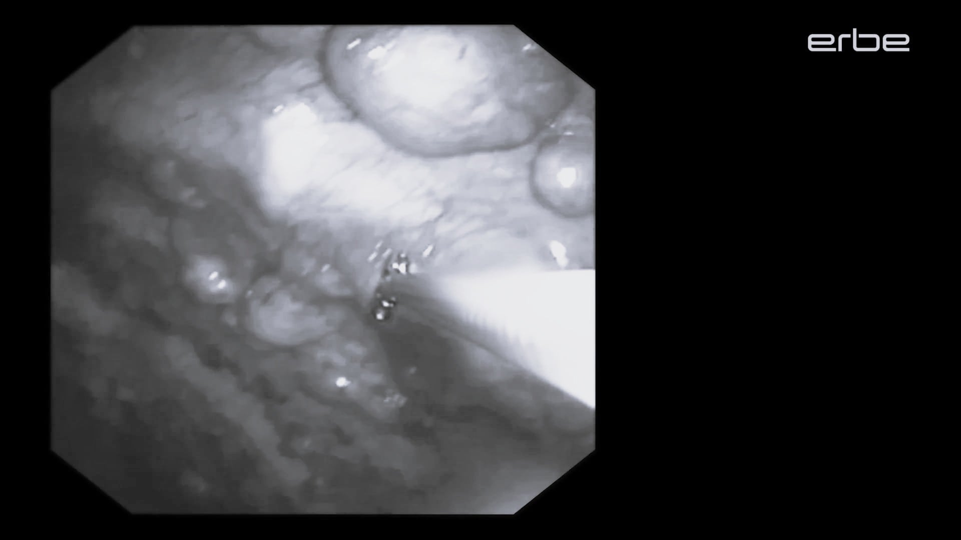 Cryobiopsy with 1.7mm Cryoprobe