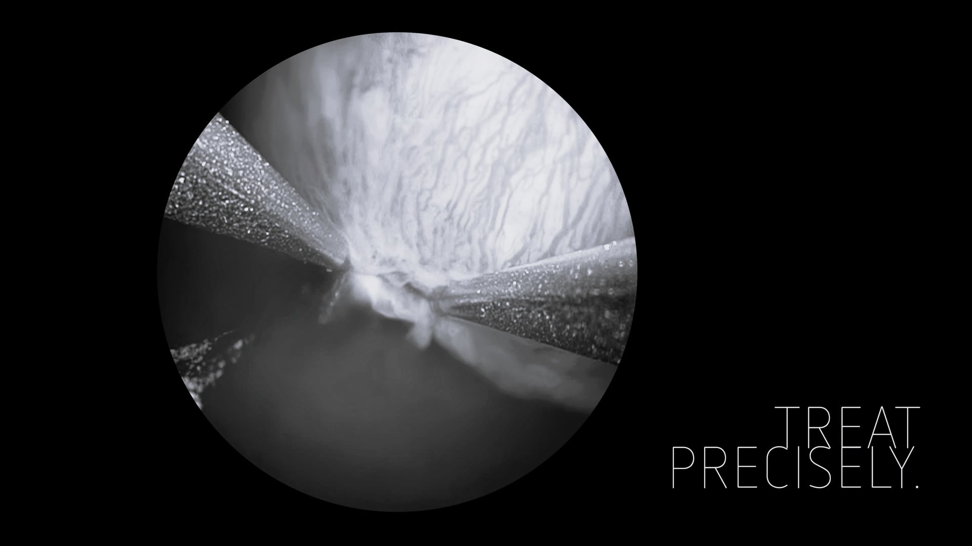 Treat precisely - Resection solution by Erbe with our VIRON 1 imaging system