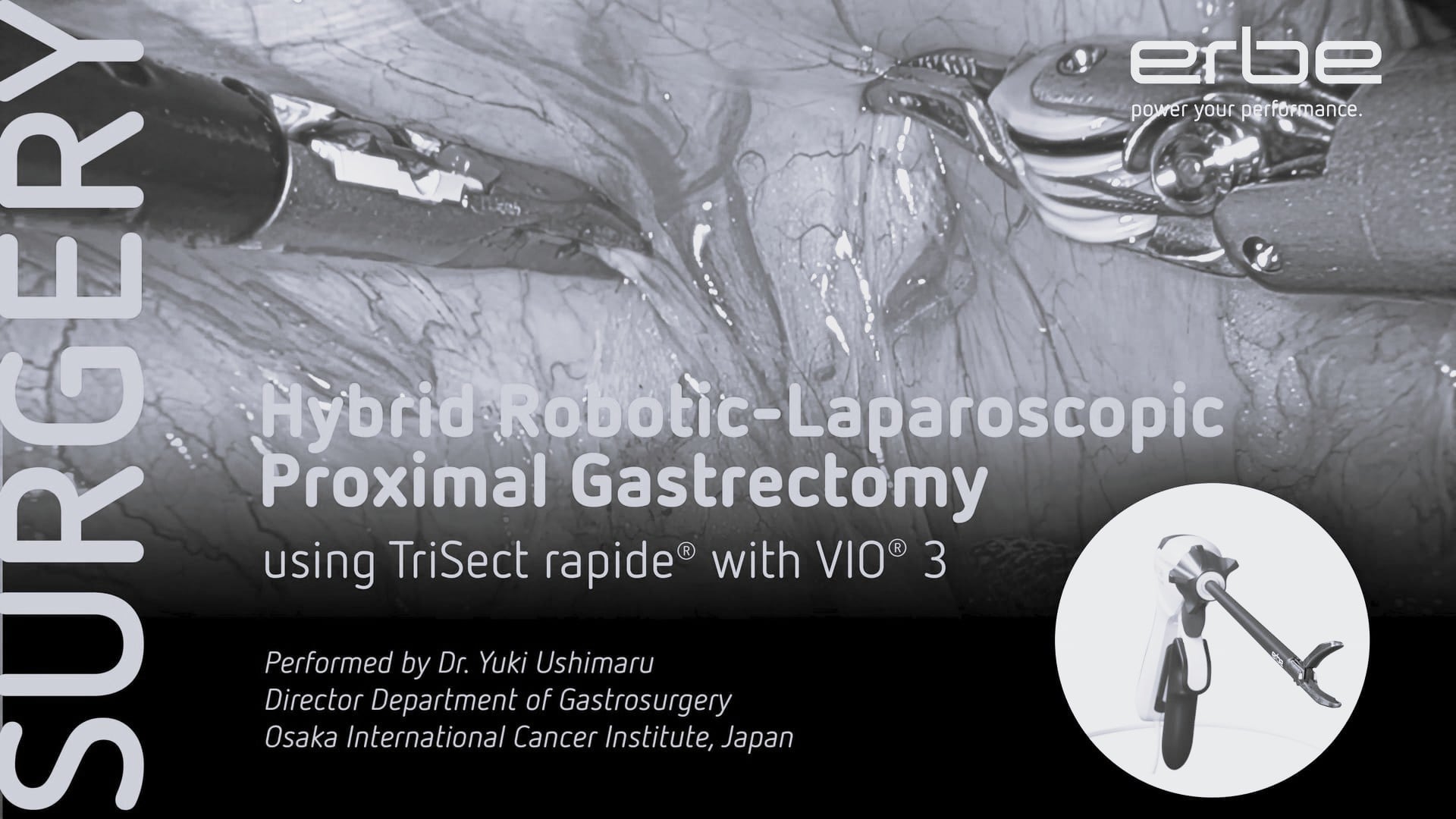 Hybrid robotic-laparoscopic gastrectomy using TriSect rapide® with VIO® 3 / Dr. Y. Ushimaru