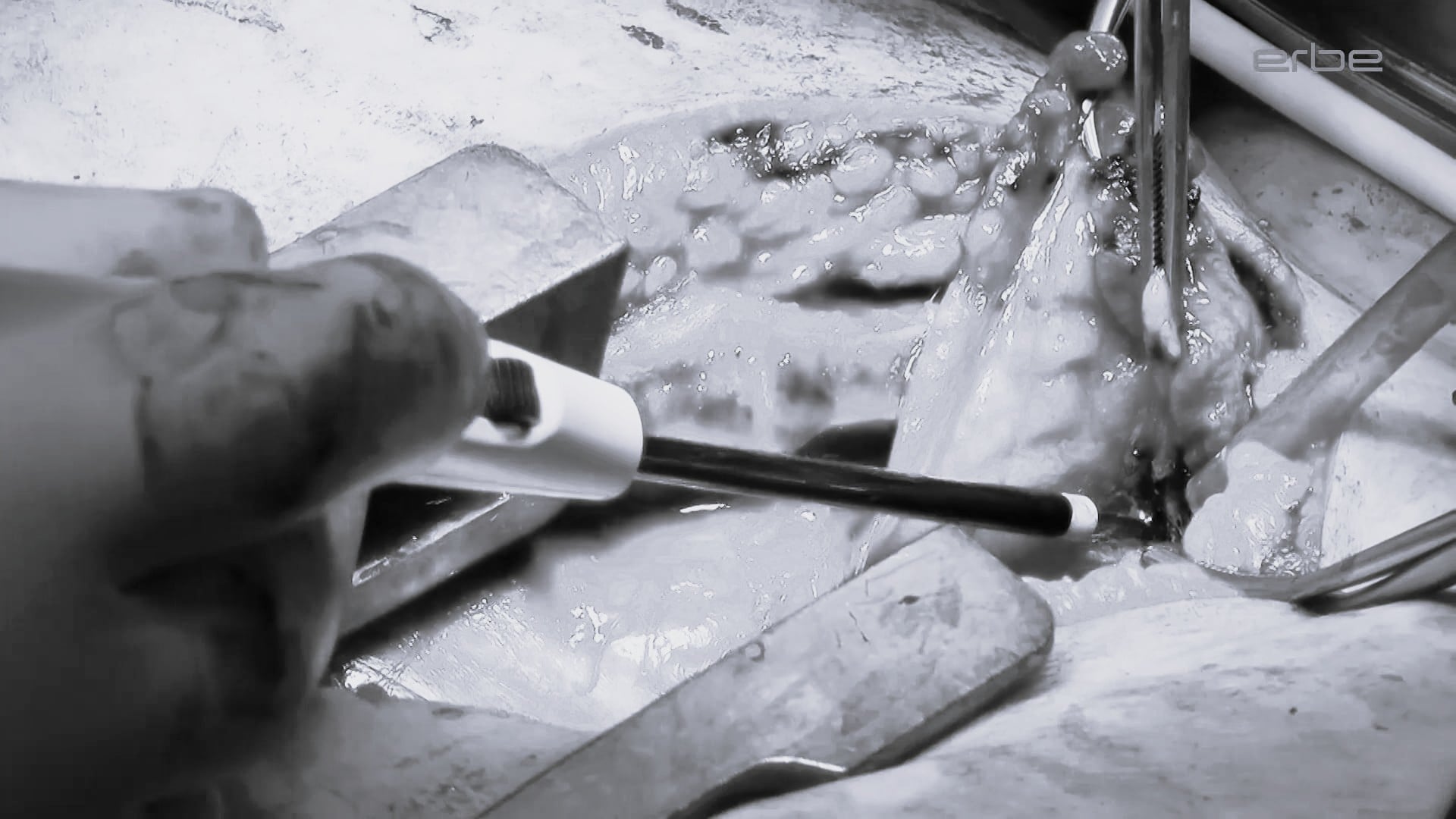 Thymus resection with APCapplicator