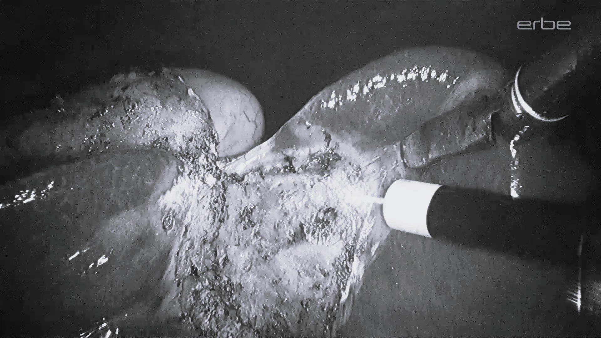 Laparoscopic cholecystectomy with APCapplicator