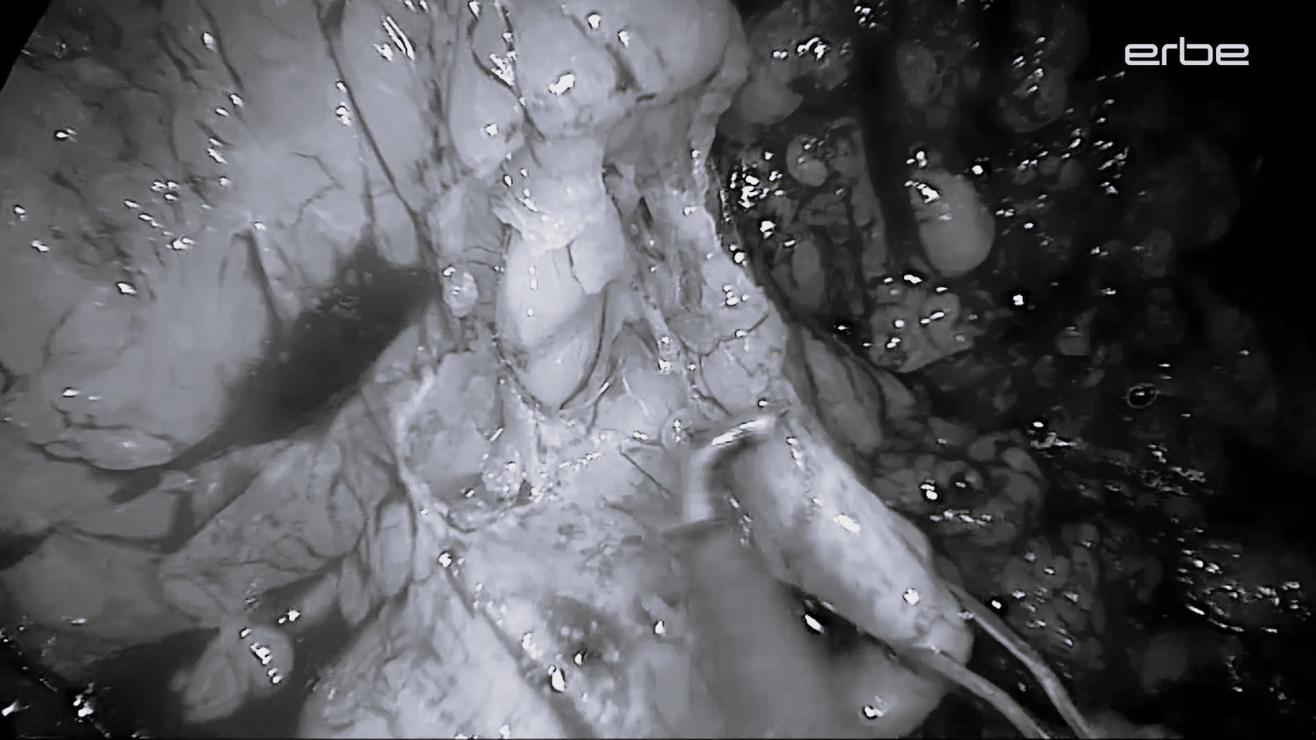 TME using the preciseSECT VIO 3 mode