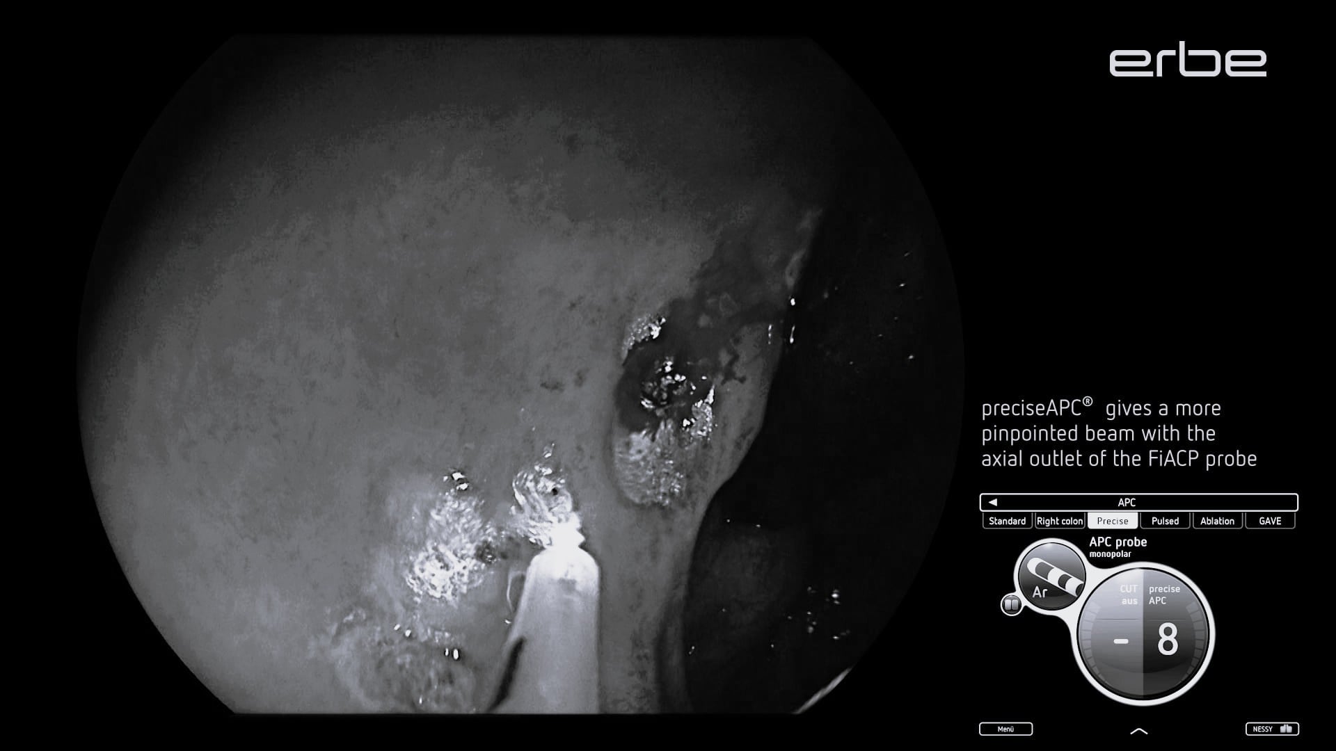 Radiation proctitis treated with preciseAPC® and pulsedAPC® mode