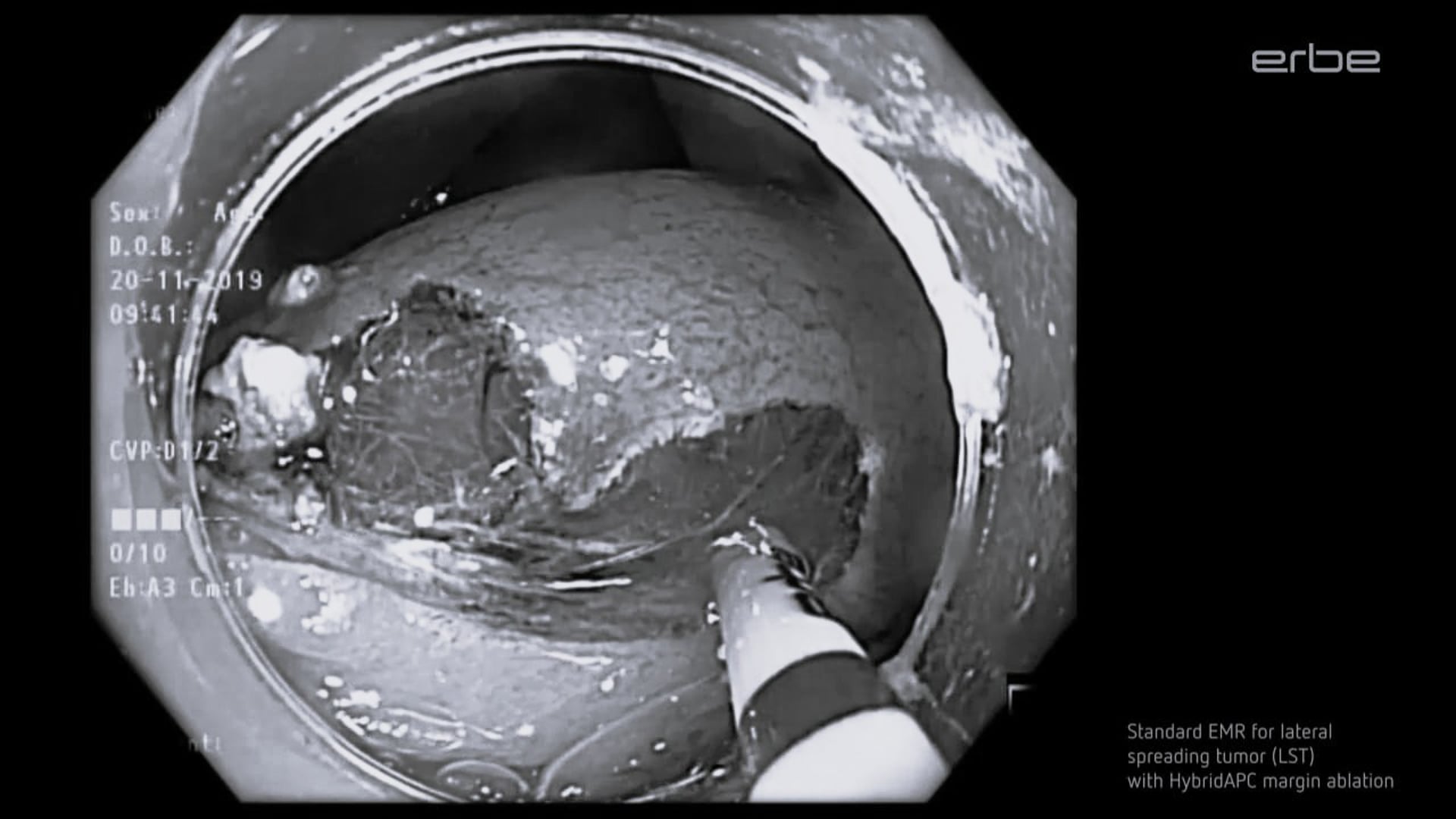 EMR for lateral spreading tumors (LST)  with HybridAPC margin ablation