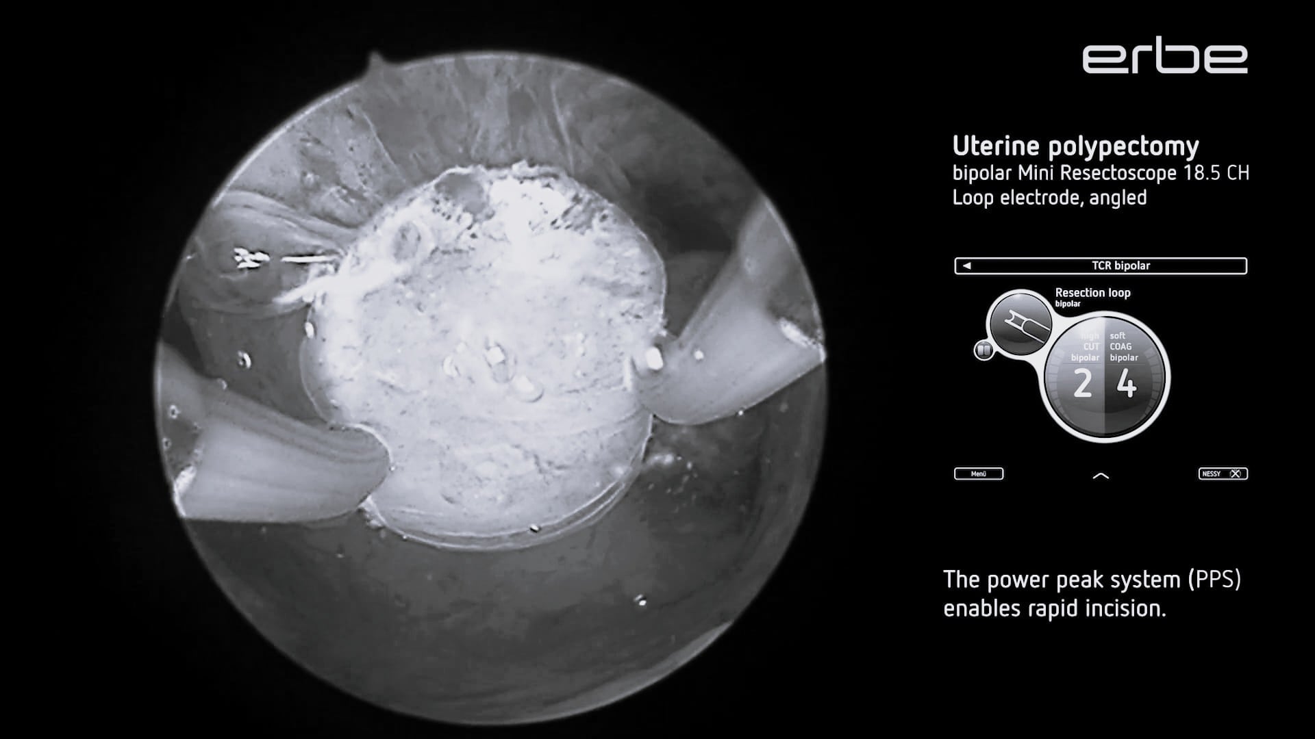 Bipolar transcervical uterine polypectomy using 18.5 CH Mini Resectoscope with VIO® 3