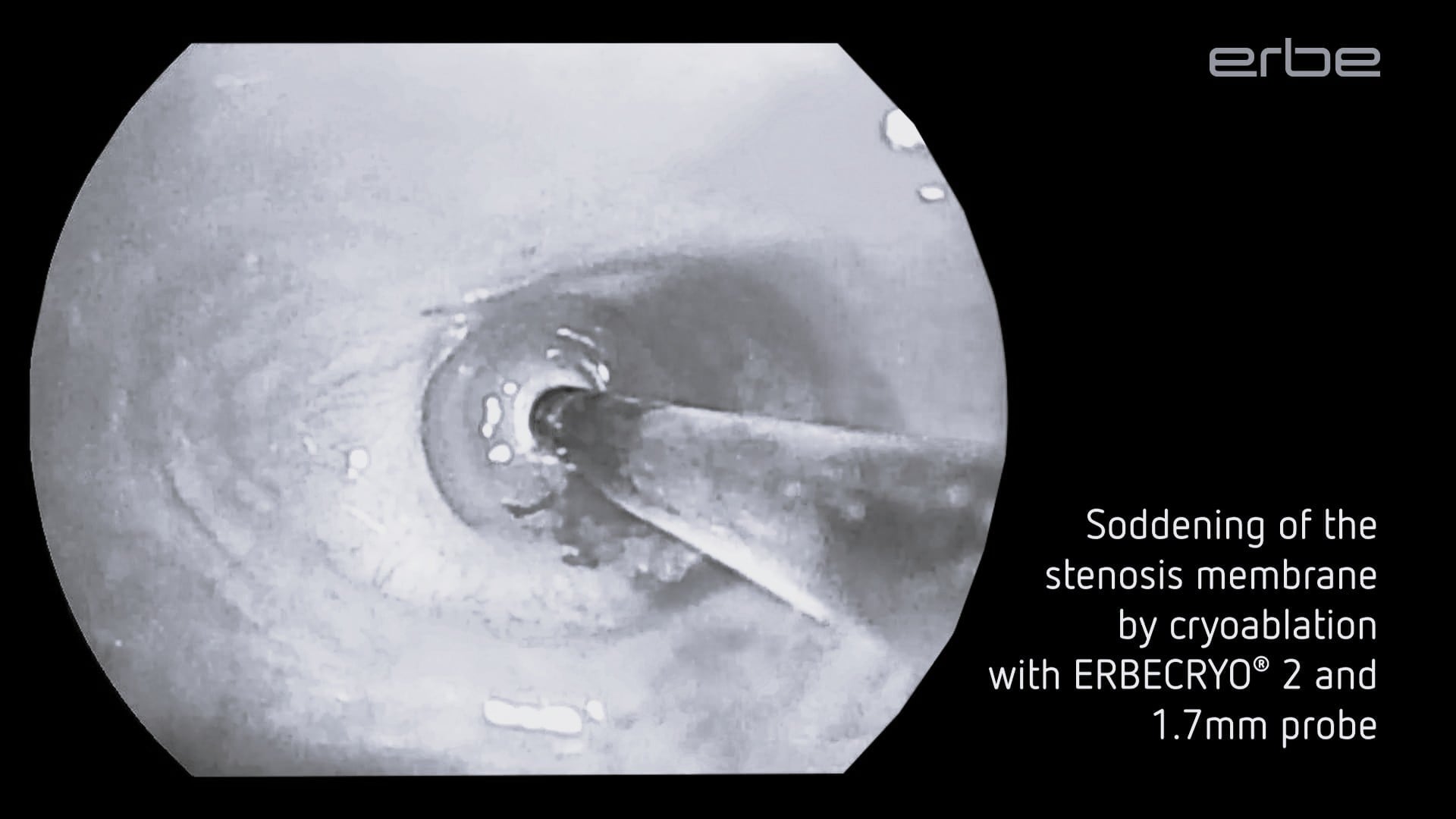 Post-Tuberculosis Bronchoscopic Cryorecanalization of Complete Stenosis in Left Upper Lobe Bronchus