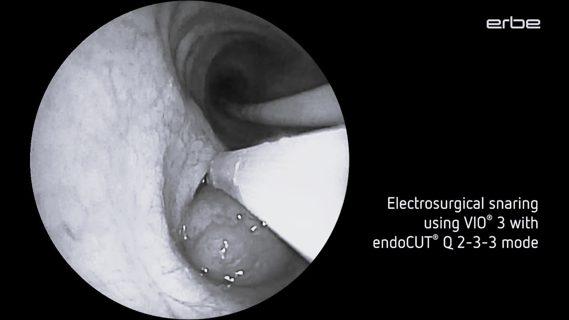 Bronchoscopic Deobstruction of Endobronchial Tumor by Electrosurgical Snaring and Cryoextraction