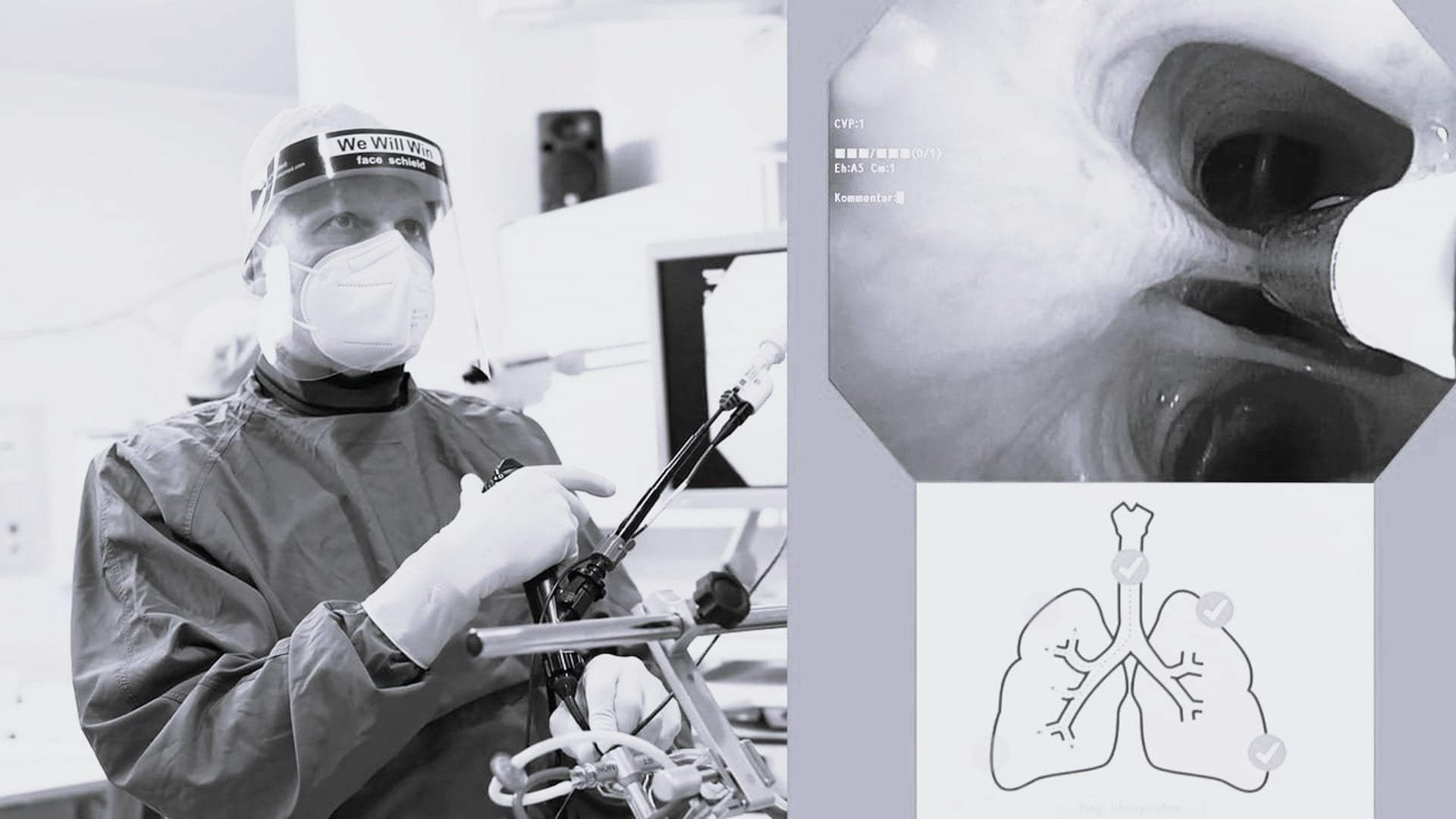 Navigated through the sheath-cryobiopsy with the flexible single-use 1.1 mm cryoprobe