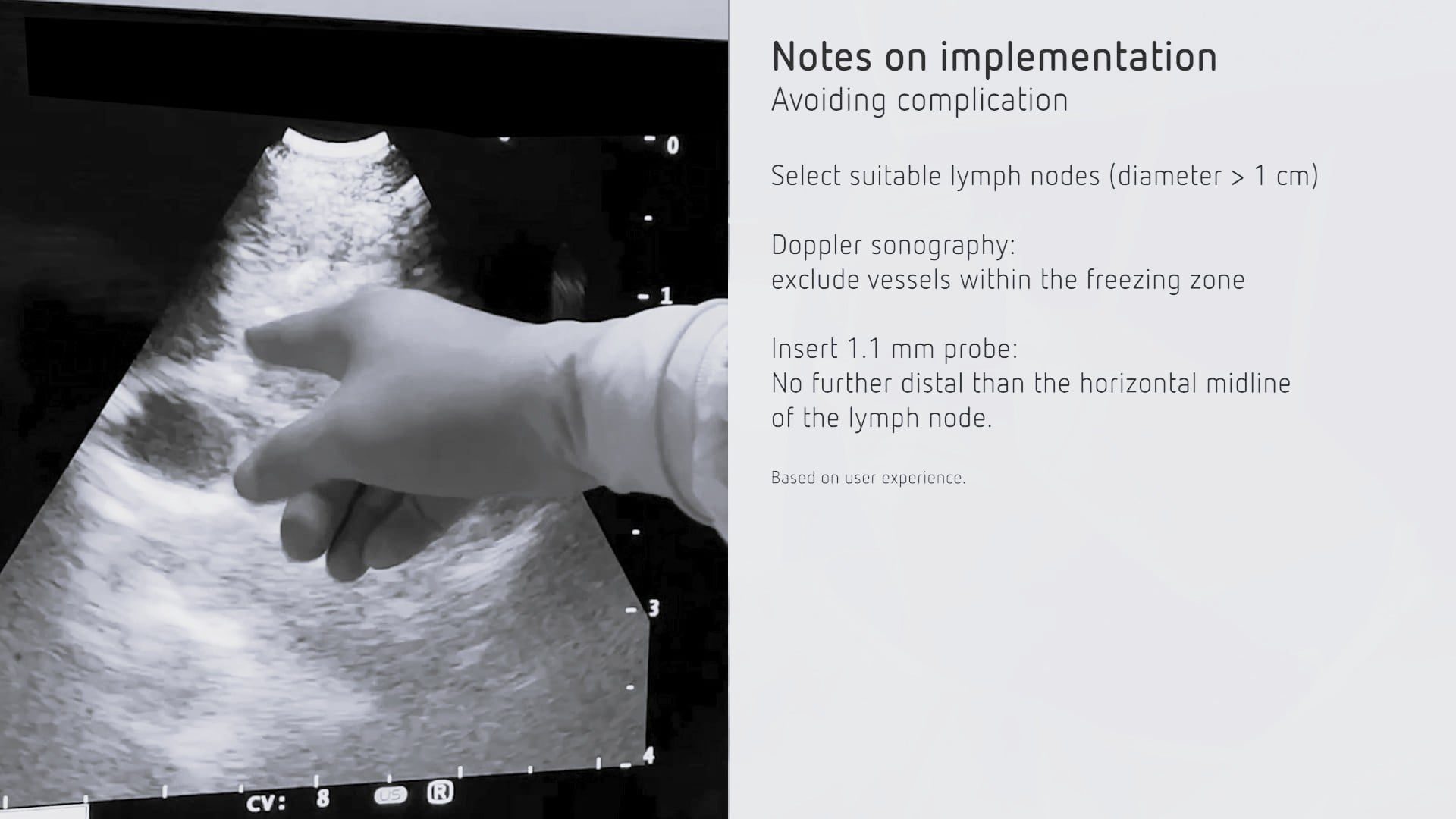 EBUS-guided mediastinal cryobiopsy of a lymph node