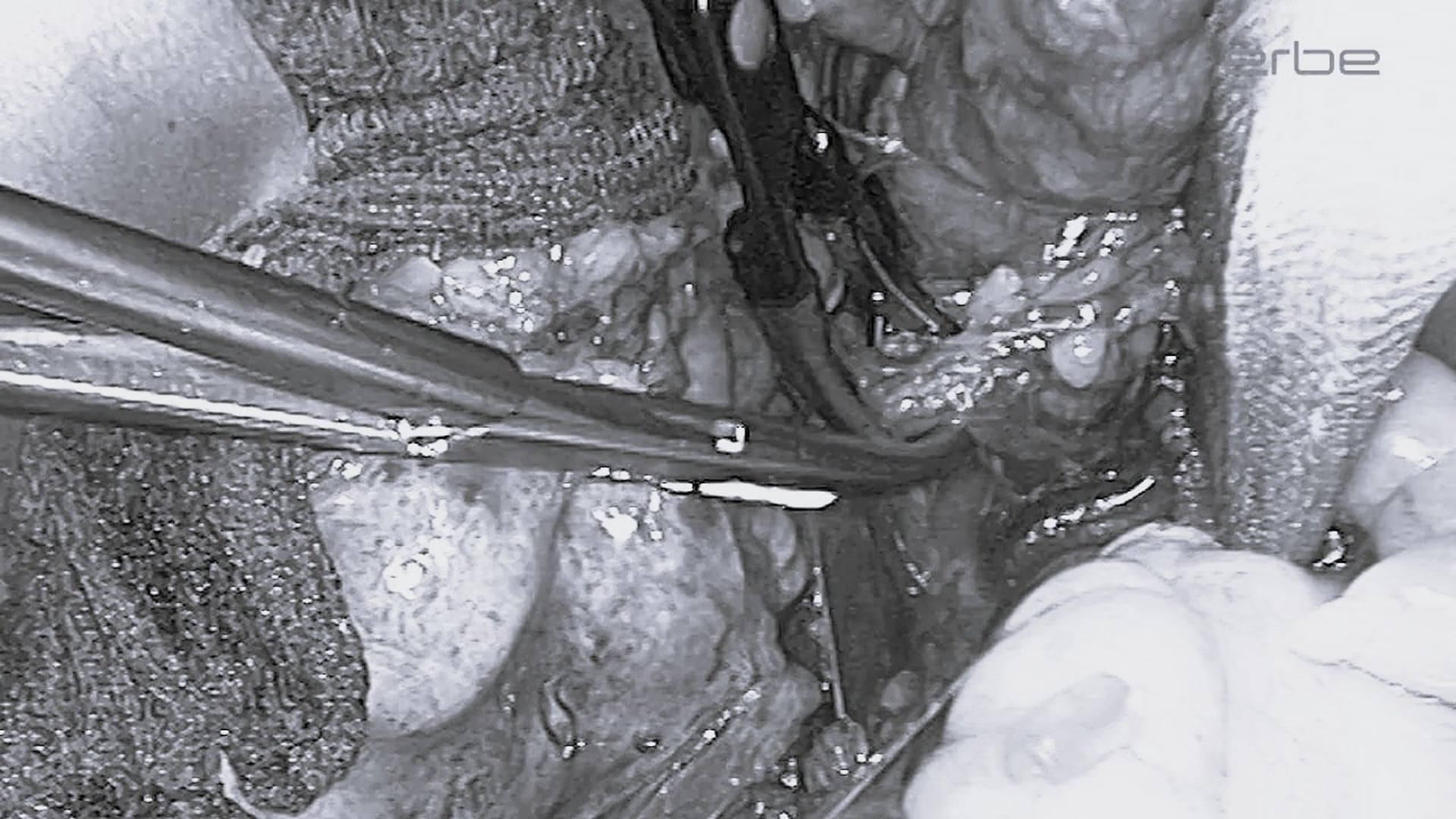 Radical cystectomy and formation of a neobladder in female patients with BiClamp®