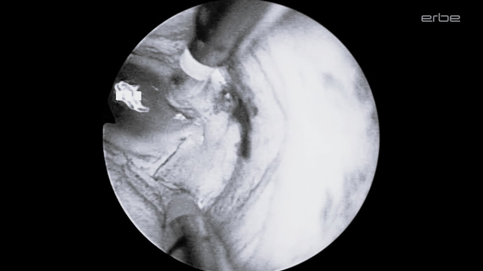 Bipolar TURP with VIO® 3