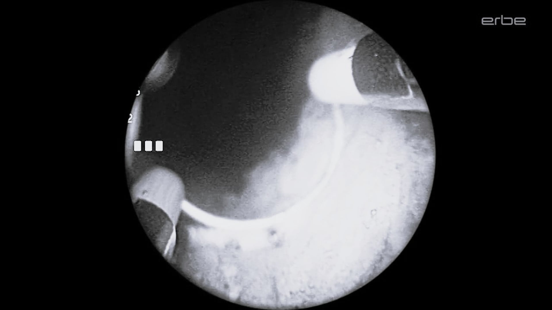 Bipolar TURBT with VIO® 3