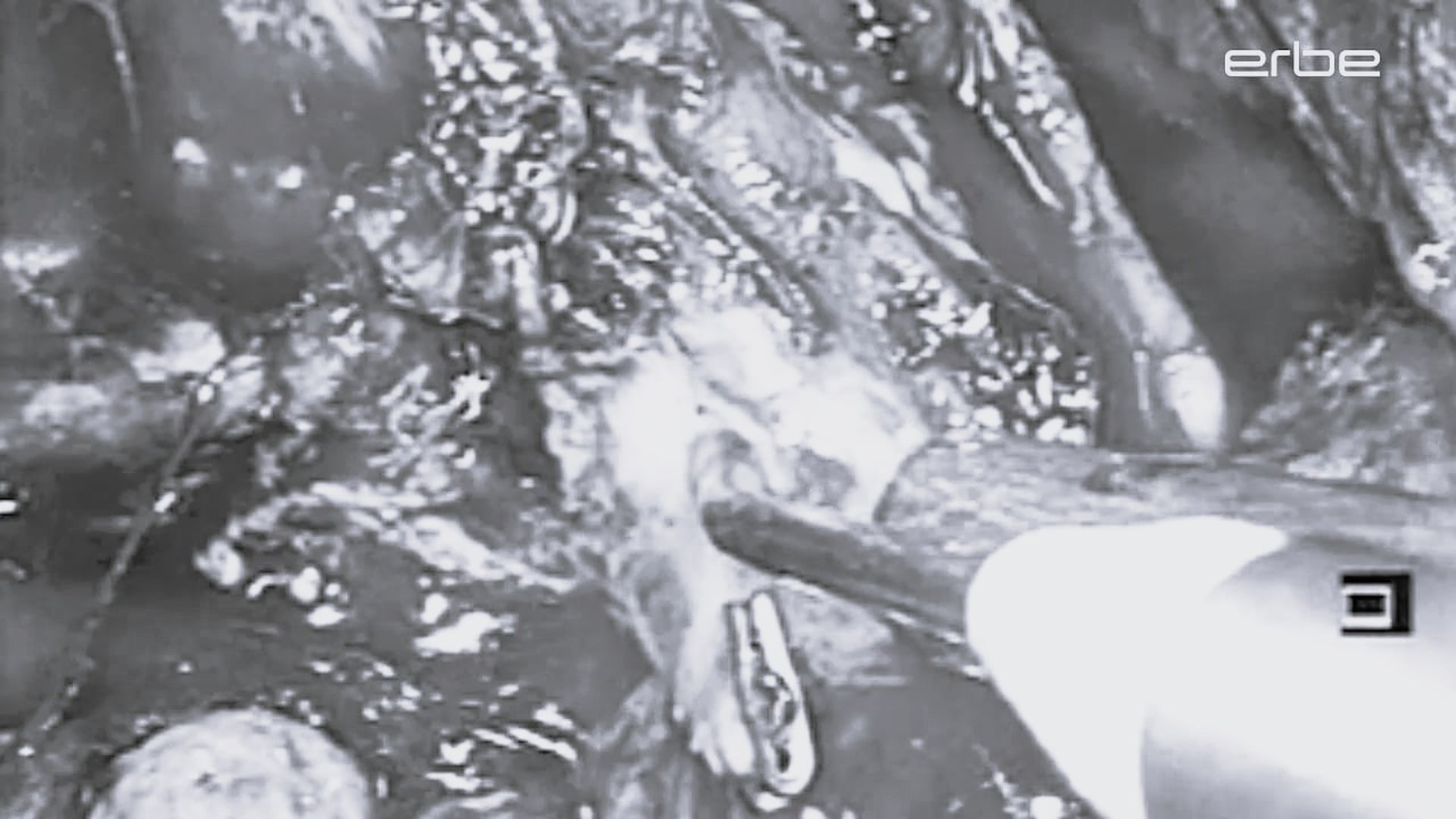 Prostatectomy, laparoscopic, with ERBEJET® 2