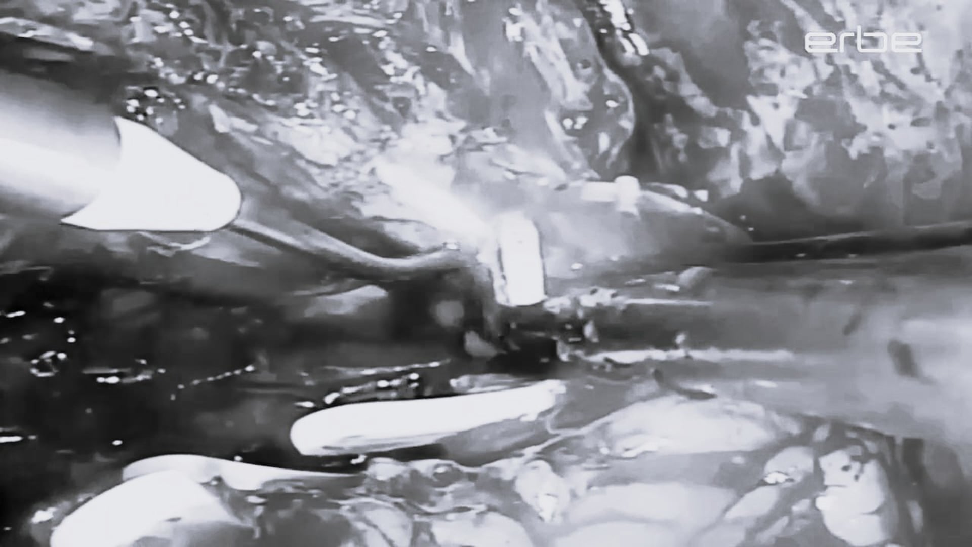 Nerve sparing laparoscopic radical prostatectomy with hydrodissection, intrafascial technique