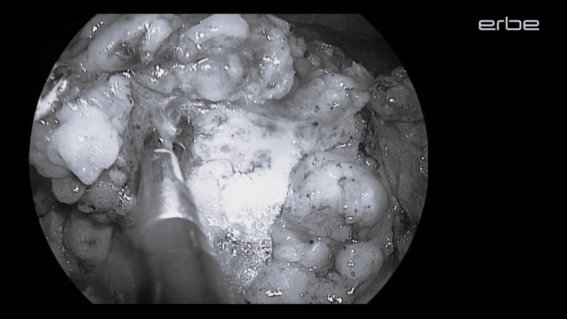 Laparoscopic partial nephrectomy with LAP BiSect Micro