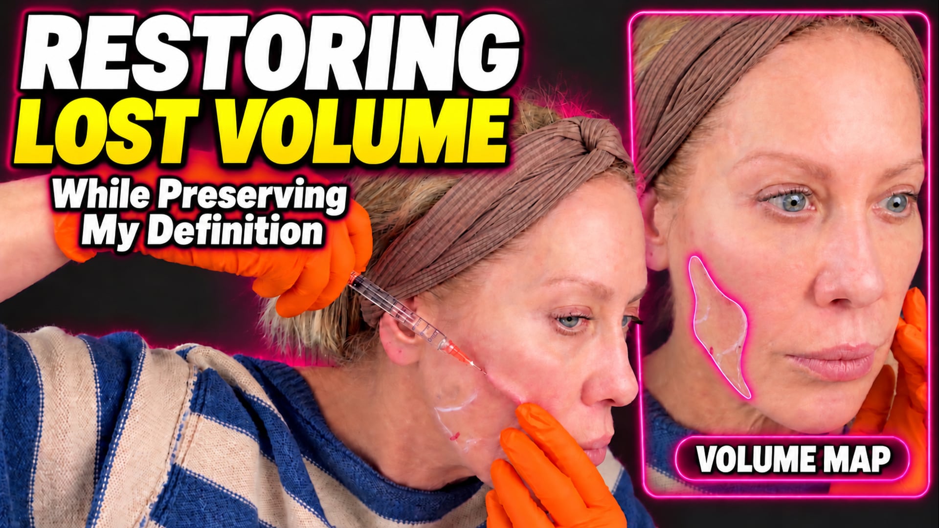 Correcting My Cheek & Antegonial Volume Without Losing Definition | Defyne + RHA 3
