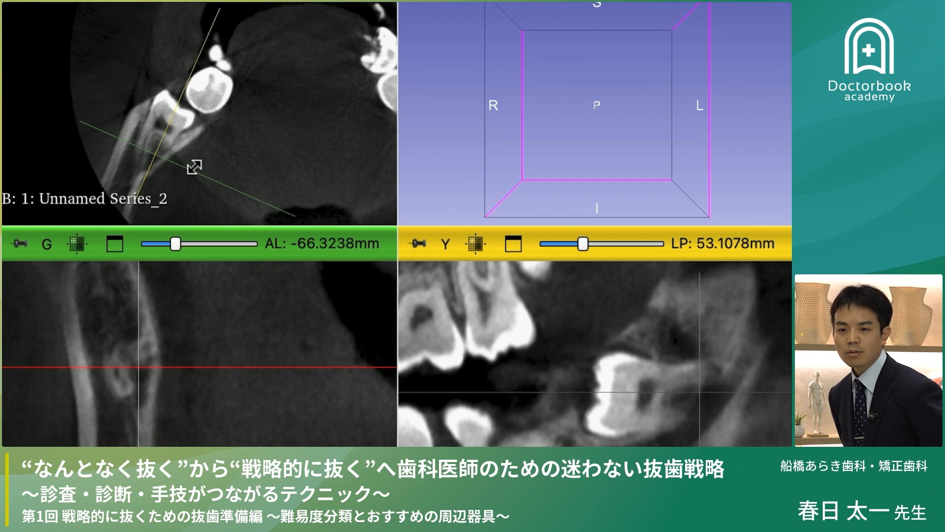 #1 戦略的に抜くための抜歯準備編〜難易度分類とおすすめの周辺器具〜 　11/2まで無料公開！