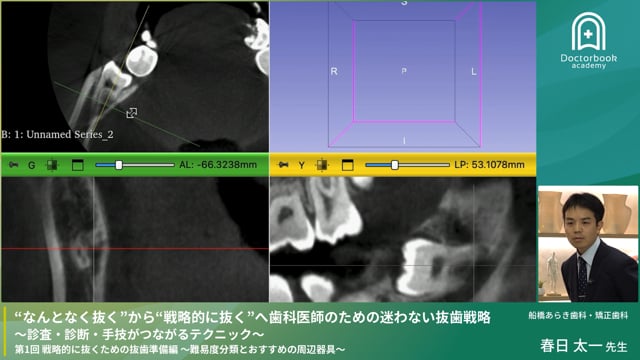 #1 戦略的に抜くための抜歯準備編〜難易度分類とおすすめの周辺器具〜 　11/2まで無料公開！