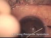 Cataract Surgery Step by Step