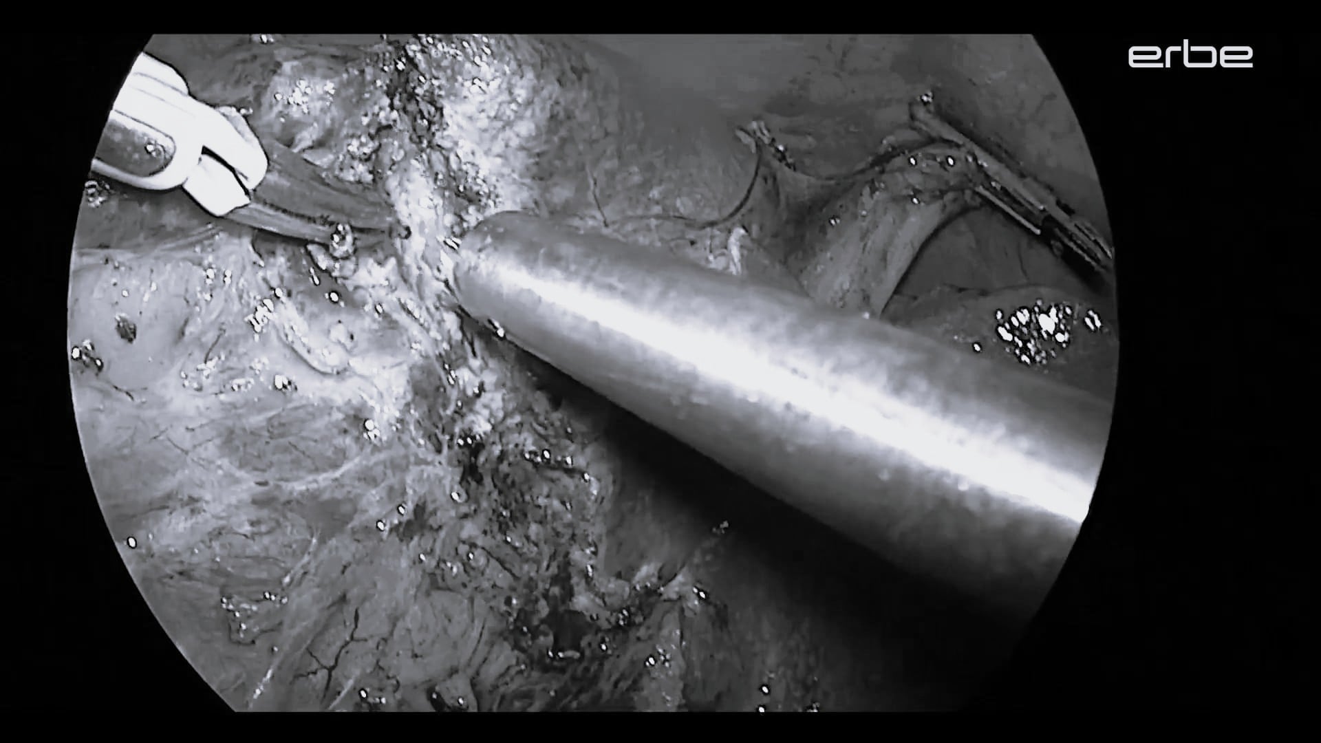 Laparoscopic liver resection with ERBEJET 2 and BiClamp LAP