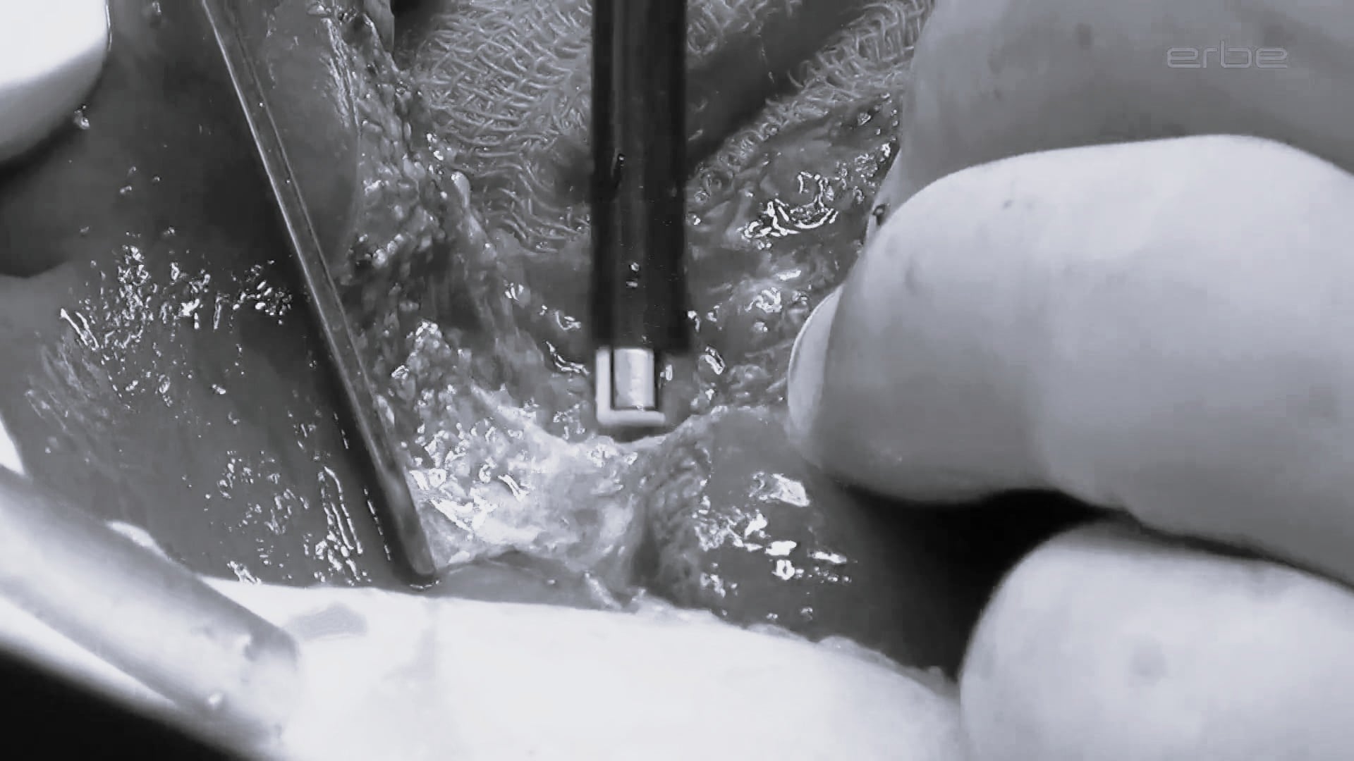 Liver resection on a newborn child with ERBEJET® 2