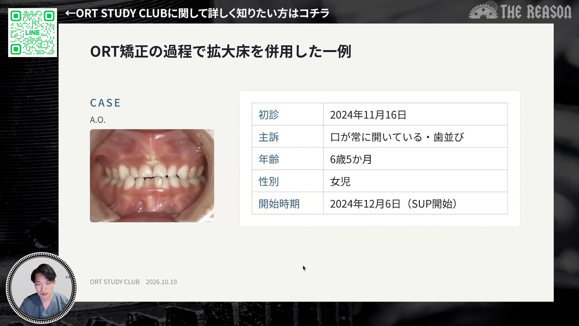 第44回 ORT矯正の過程で拡大床を併用した一例