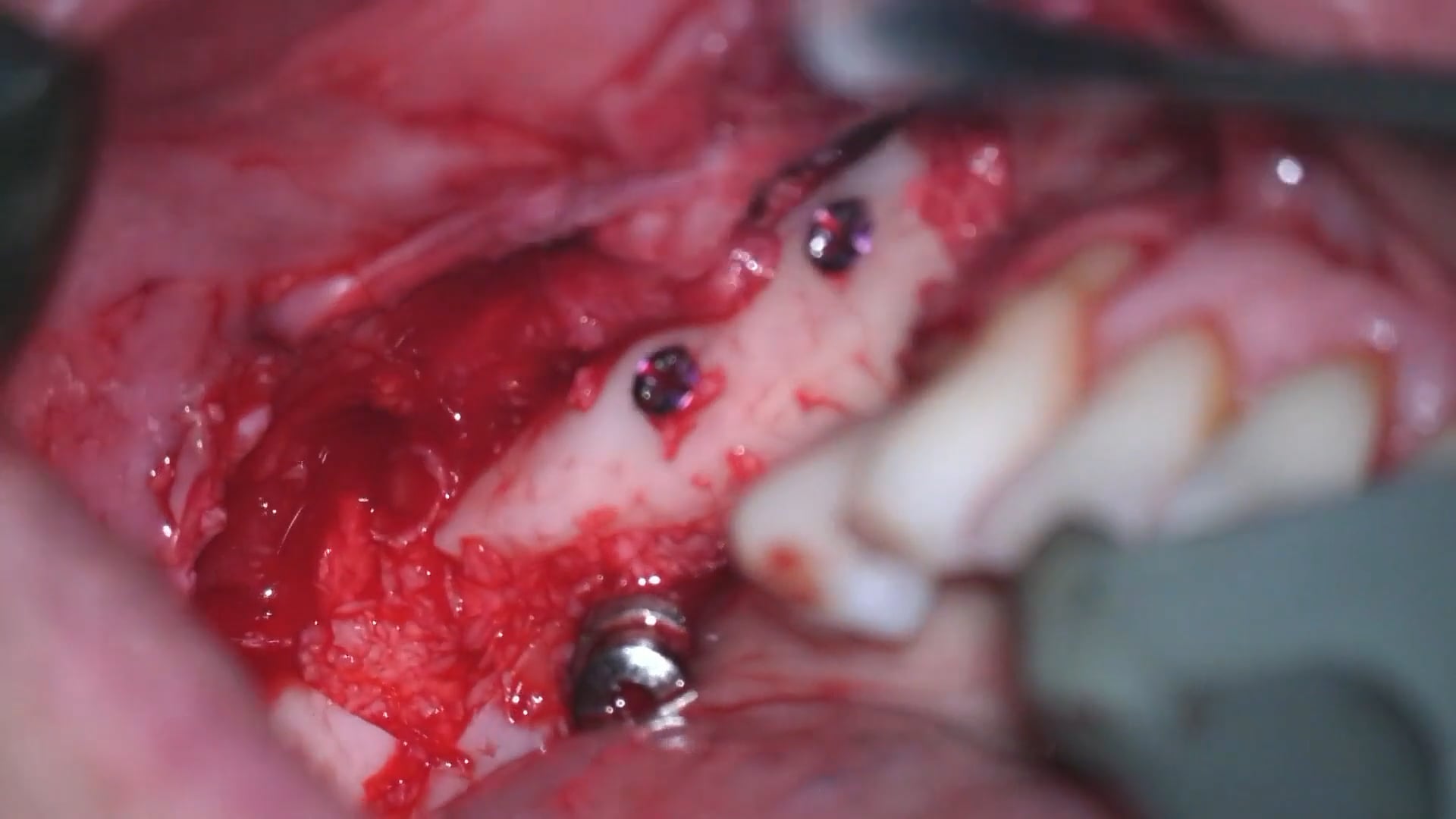 Trasposición del nervio alveolodentario para rehabilitación con implantes bajo anestesia general