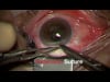 Retinal Detachment with PVR and Macular Hole