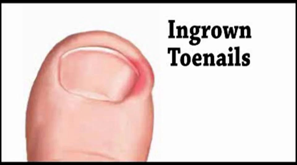 ingrown-toenail-treatment-chiropodist-in-toronto-on-on-vimeo