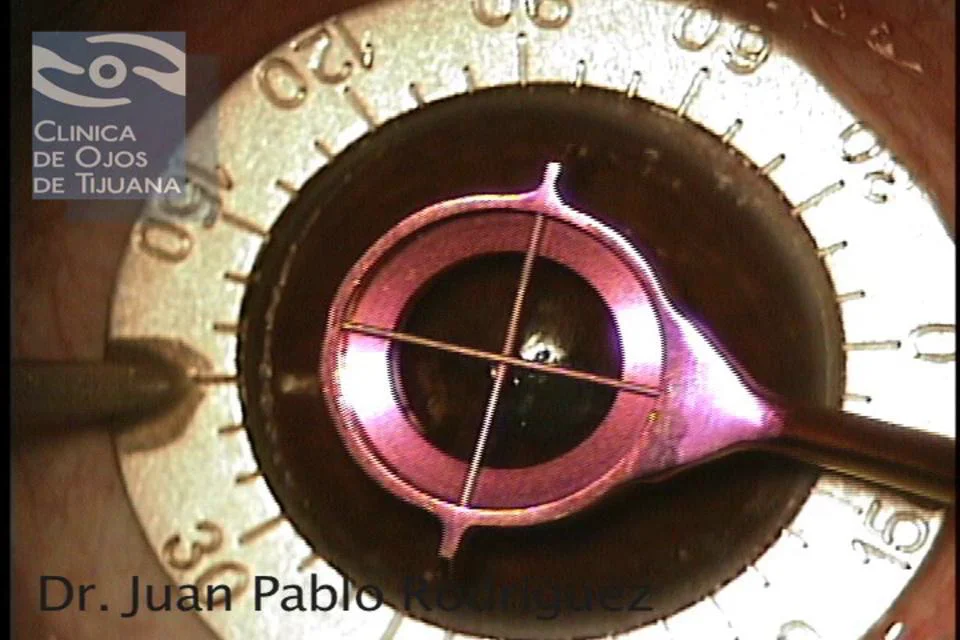Anillos Intraestromales (Intrastromal Corneal Rings) on Vimeo