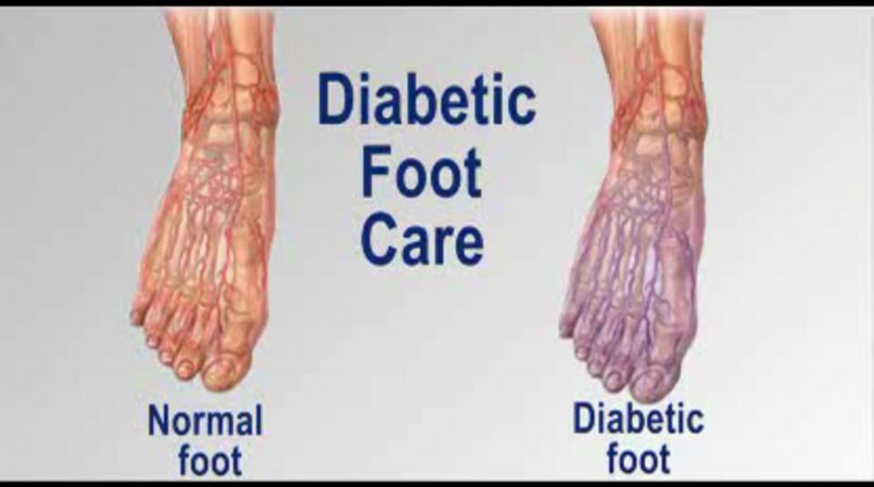 Diabetic Foot Care - Podiatrist In Frederick, Hagerstown And Germantown 