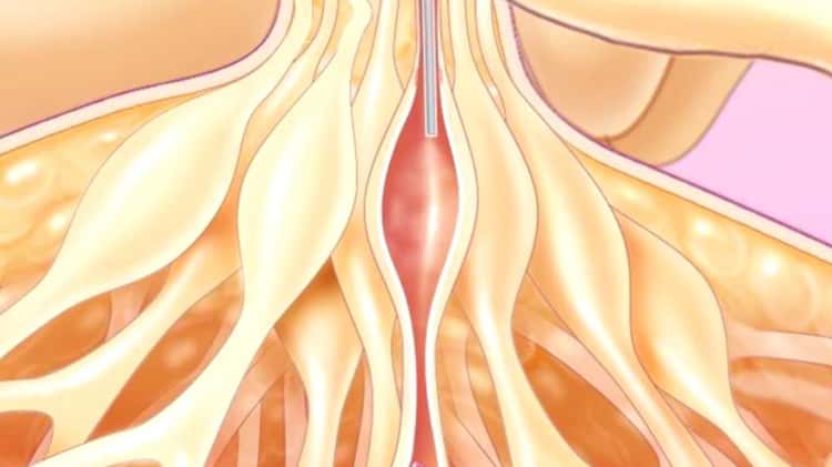 Excilor trattamento dei fibromi penduli on Vimeo