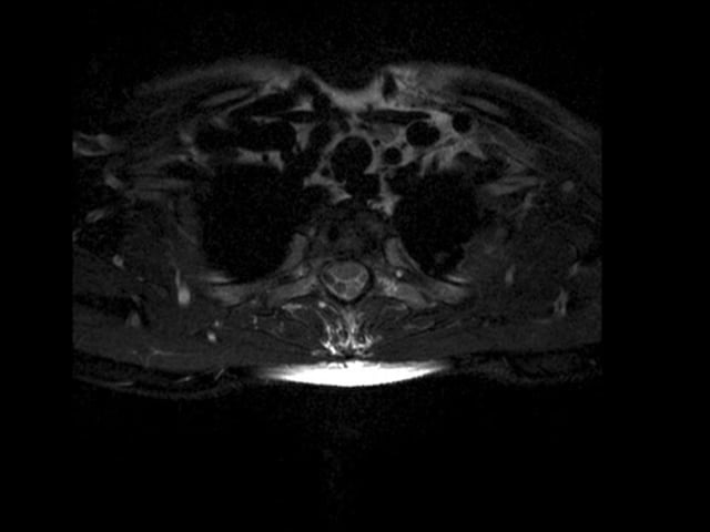 Vertebrectomía de T2