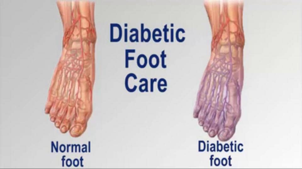 Mark Reiner, DPM - Diabetic Foot Care – Podiatrist in Jonesboro, AR on ...