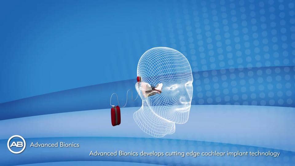 Advanced Bionics HiResolution Bionic Ear system HiRes90K cochlear
