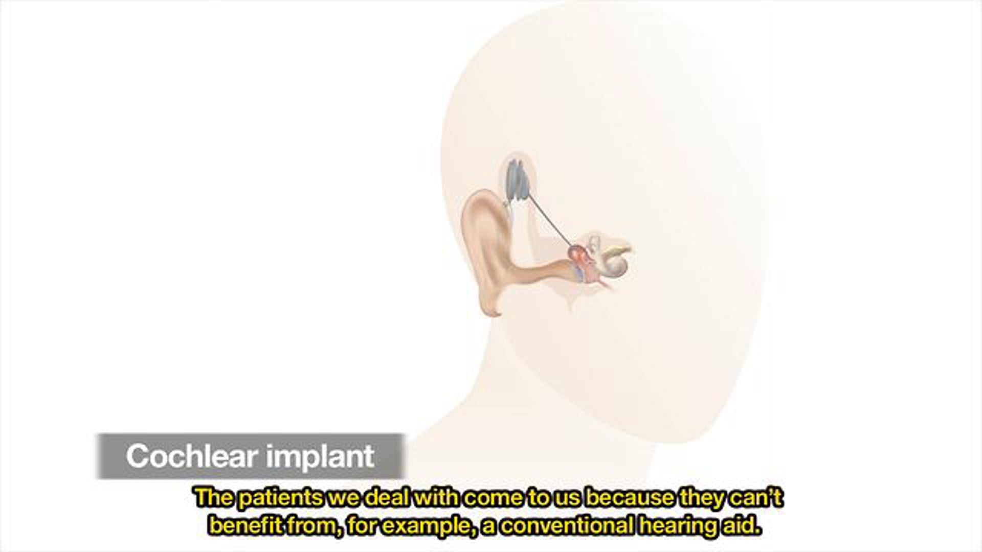 Hearing Cochlear Implants w/ open captions
