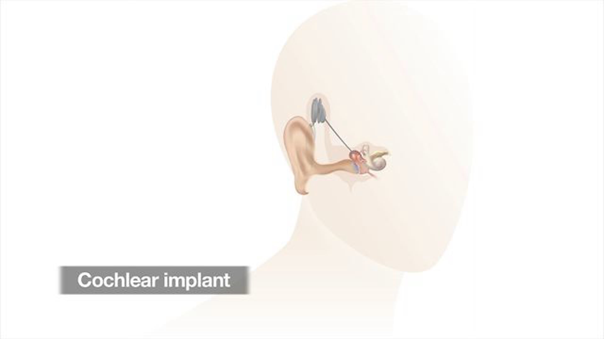 Hearing Cochlear Implants