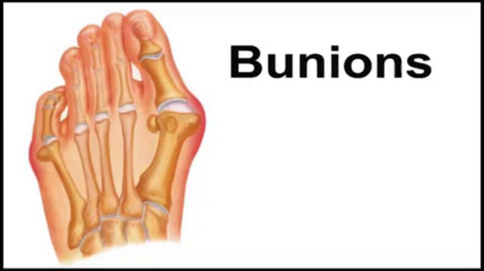 Bunions Treatment Podiatrist in NYC Lower Manhattan Maiden Lane Podiatry on Vimeo