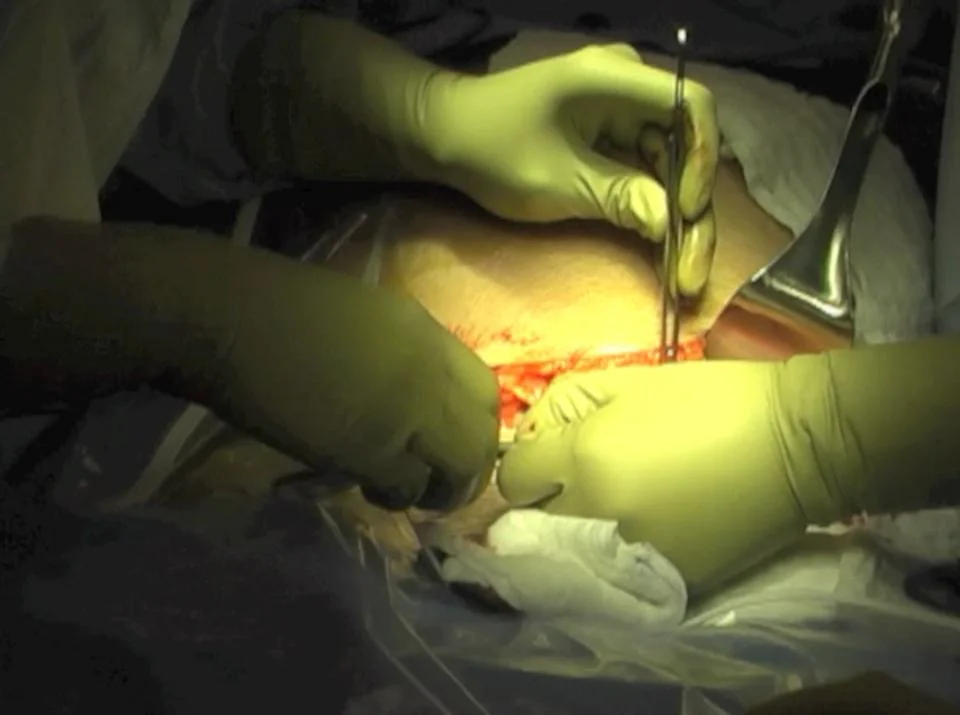 C - section - Cesarean delivery in live (Full) 