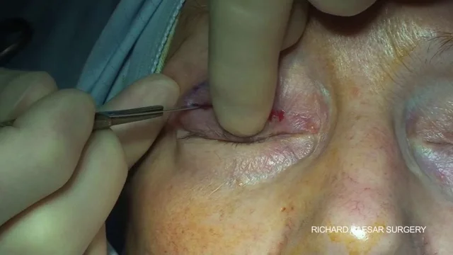 Eyelid deals surgery video