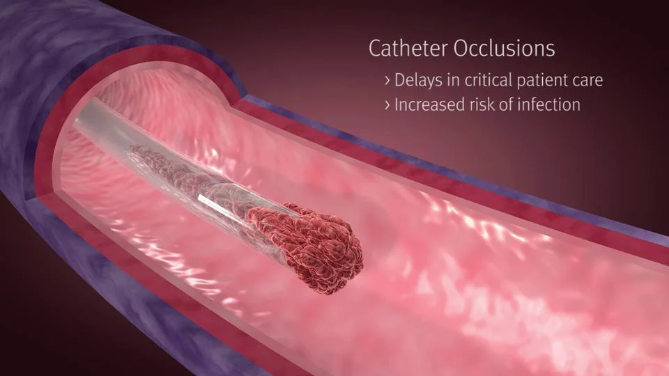 IV Connectors - Neutron Catheter Patency Device on Vimeo