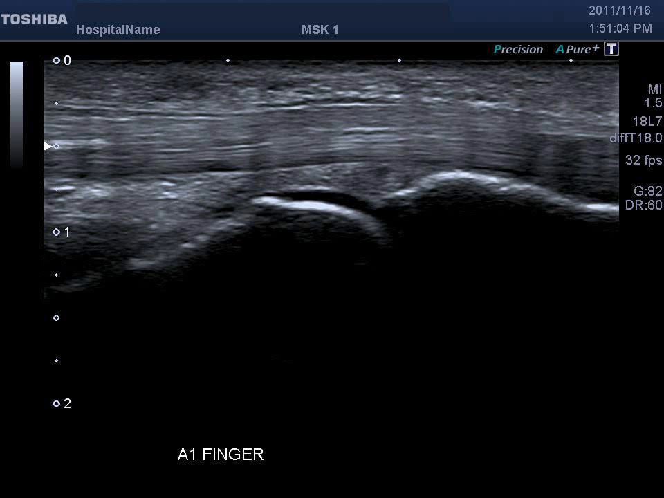 ultrasound of the A1 pulley of the finger together with the flexor