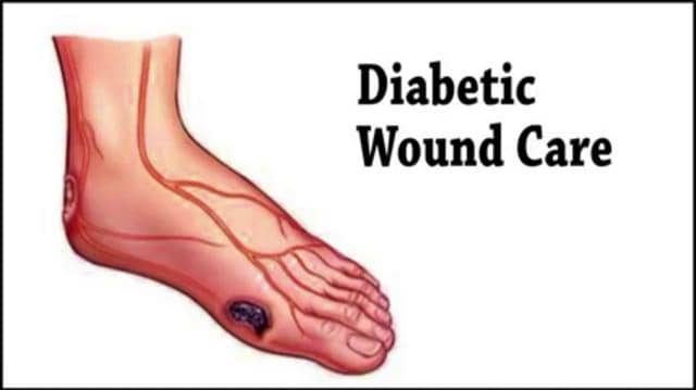 Diabetic Wound Care - Podiatrist in Midlothian and Chesterfield, VA ...